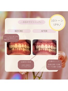 プラスビー 2号店(+b)/ホワイトニングビフォーアフター