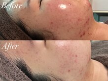 アンドナイン エス店(ANDNINE.)/ハーブピーリングBeforeAfter