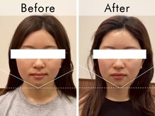 ハリラウンジ 梅田店(Hari Lounge)/美容鍼専門サロン Hari Lounge