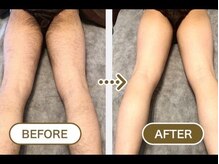 チャッピー(CHAPPY)/メンズ　足脱毛