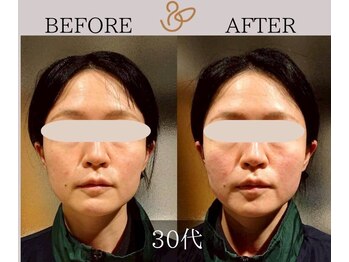 チョコバリ プラス(chocobari plus)/小顔×リフトアップ(美容)30代