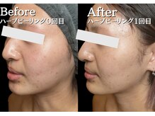 美意識/1回目でニキビの赤み引いてます