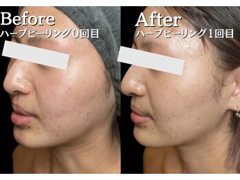 美意識/1回目でニキビの赤み引いてます