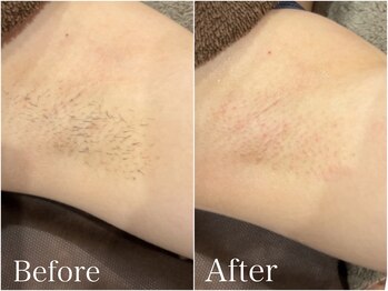 ジョエルワックス 沖縄那覇店(JOELLE WAX)/新規★両脇ダブル(wax＋光)