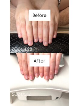 サロンドエヌ(Salon de N)/深爪矯正は、初回から綺麗に