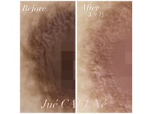 ジュエカフネ 広尾(JueCAFUNe)/ルメラメラニンケア、バスト症例