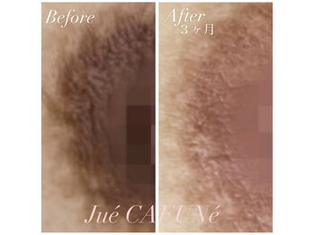 ジュエカフネ 広尾(JueCAFUNe)/ルメラメラニンケア、バスト症例