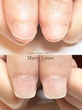 マリーロール 梅田店(Marie Laure)/自爪育成/深爪矯正/ネイルケア