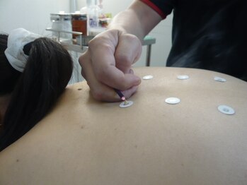 アタック鍼灸院(ATAC鍼灸院)/背部へのお灸