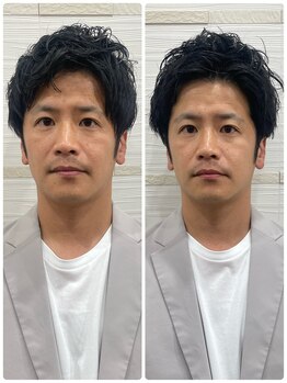 長寿鍼灸院 長寿整骨院/men's美容鍼50本効果★