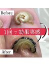 巻き爪矯正 ビフォーアフター