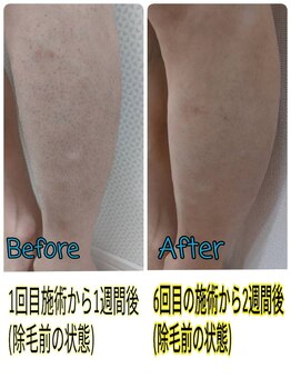 セルフメイド 石巻店/【ビフォーアフター】セルフ脱毛