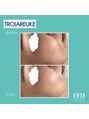 エフエフディースキンケア(FFD SKINCARE)&nbsp;施術例