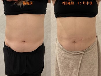 ココ(Coco)/脂肪冷却