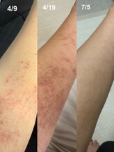 ココユール(cocoyull)/ハーブテントで肌質やかゆみ改善