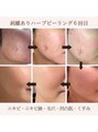 エイナミビューティサロン/エイナミビューティーサロン★肌質改善毛穴