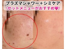 ベルファーム(Belle Femme)/プラズマ＋シミケアセット♪