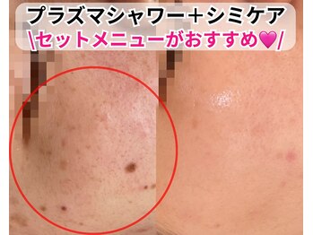 ベルファーム(Belle Femme)/プラズマ＋シミケアセット♪