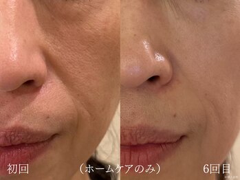 ウォーム(warm)/シワケア/小顔/マッサージ/小顔