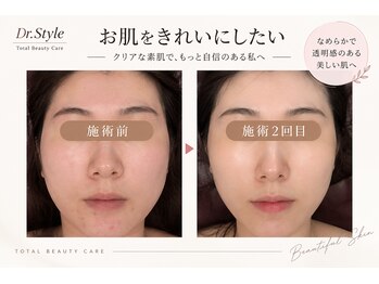 ドクタースタイル(Dr.style)の写真/汗・皮脂で詰まりやすい毛穴を秋にしっかり毛穴洗浄/ラフォス/小顔リンパ/超音波5000shotで憧れ/たまご肌へ