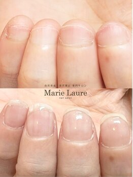 マリーロール 梅田店(Marie Laure)/自爪育成/深爪矯正/ネイルケア