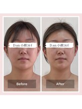 ディードットアン(D.an)/小顔コルギ