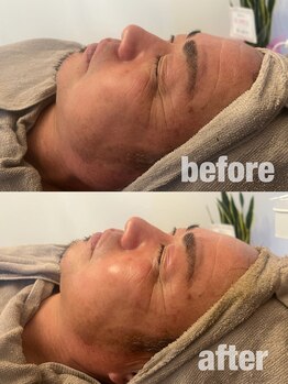 ベル(Belle)/ハーブピーリングbefore→after