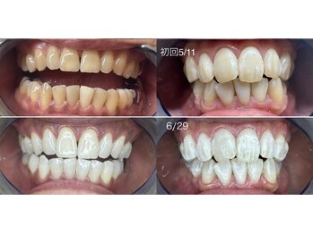 アンベリール(Embellir)/《大人気》セルフホワイトニング