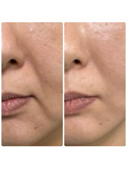 リミューズ マロアマーノ(Re.MUSE MAROaMano)/ララピール1回目LHALALAピール