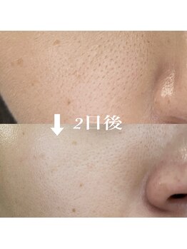 コリー(Kolly)/リフェイス"部分コース"