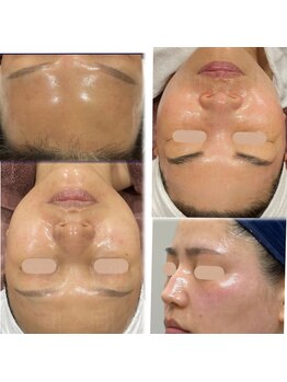 ジオリッチシフォン(giorich chiffon)/スーパージェクション★エクソロ