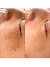 ベルエクラ(Bel Eclat)/モヤモヤしみ改善/那覇