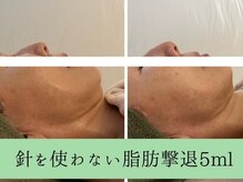 ソルニス(Solnis.)/小顔☆脂肪分解/ハイパーナイフ