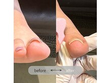 経験豊富な講師による巻き爪ケアもございます！