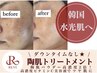 【毛穴&皮脂ケア】ハーブピーリング+高濃度ビタミンC美容液導入