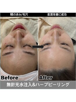 マヴィ 香里園店(MavY.)/肌トラブルにはハーブピーリング