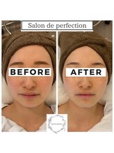 サロン ド パーフェクション(Salon de Perfection)/小顔リフト