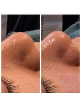 ラデュープラス(Radieux+)/韓国式3D毛穴洗浄