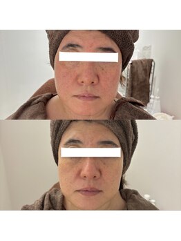 ホロニック ベルサンテ(Holonic Belle Sante)/赤み/くすみ/毛穴