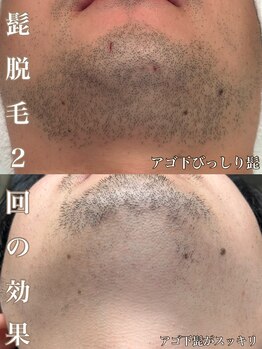 サロン ド マキ(Salon de Maki)/脱毛2回でこの効果!!!