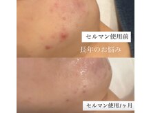 20代のお客様1ヶ月の変化お肌の根本から育てるケア