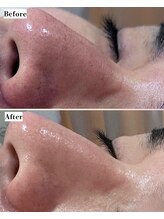 ソワナ(soina)/【神楽坂駅/フェイシャル/毛穴】