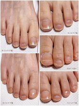 ディグニティ(Dignity)/フットネイルケア/育爪ケア