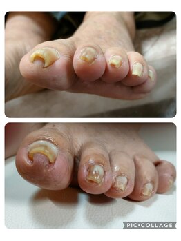 ビソク(VISOK)/まき爪矯正です