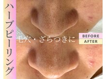 Cスキンケアクリニック 麻布店/ハーブピーリングBeforeAfter