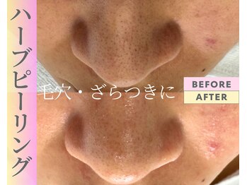 Cスキンケアクリニック 麻布店/ハーブピーリングBeforeAfter