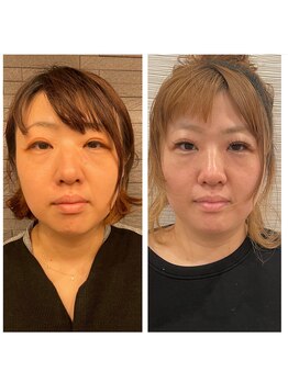 長寿鍼灸院 長寿整骨院/ハリネズミ女優美容鍼効果★