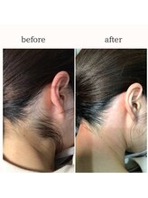 カルーナ 住吉店/えりあしMIX脱毛