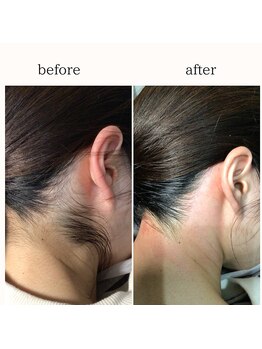 カルーナ 住吉店/えりあしMIX脱毛