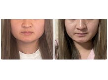 小顔矯正サロン ブルーム/1回の施術でエラ張り解消